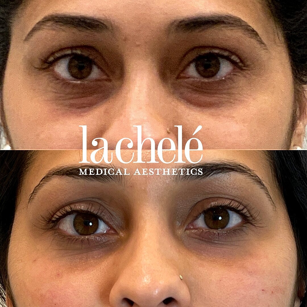 Everything You Need to Know About Cheek and Under Eye Filler