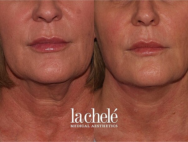 Want to Know More about the Non-Surgical Alternative To A Facelift? Let’s talk PDO Thread Lift.