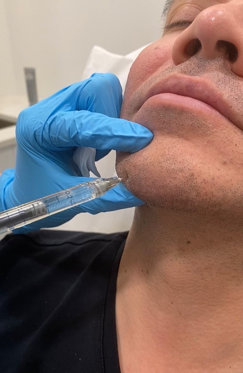 What is Chin & Jawline Contouring