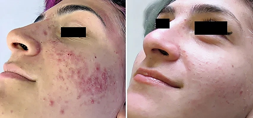 Before and after acne treatment comparison.