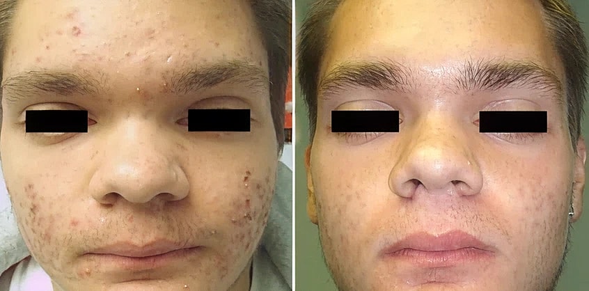 Before and after acne treatment comparison.