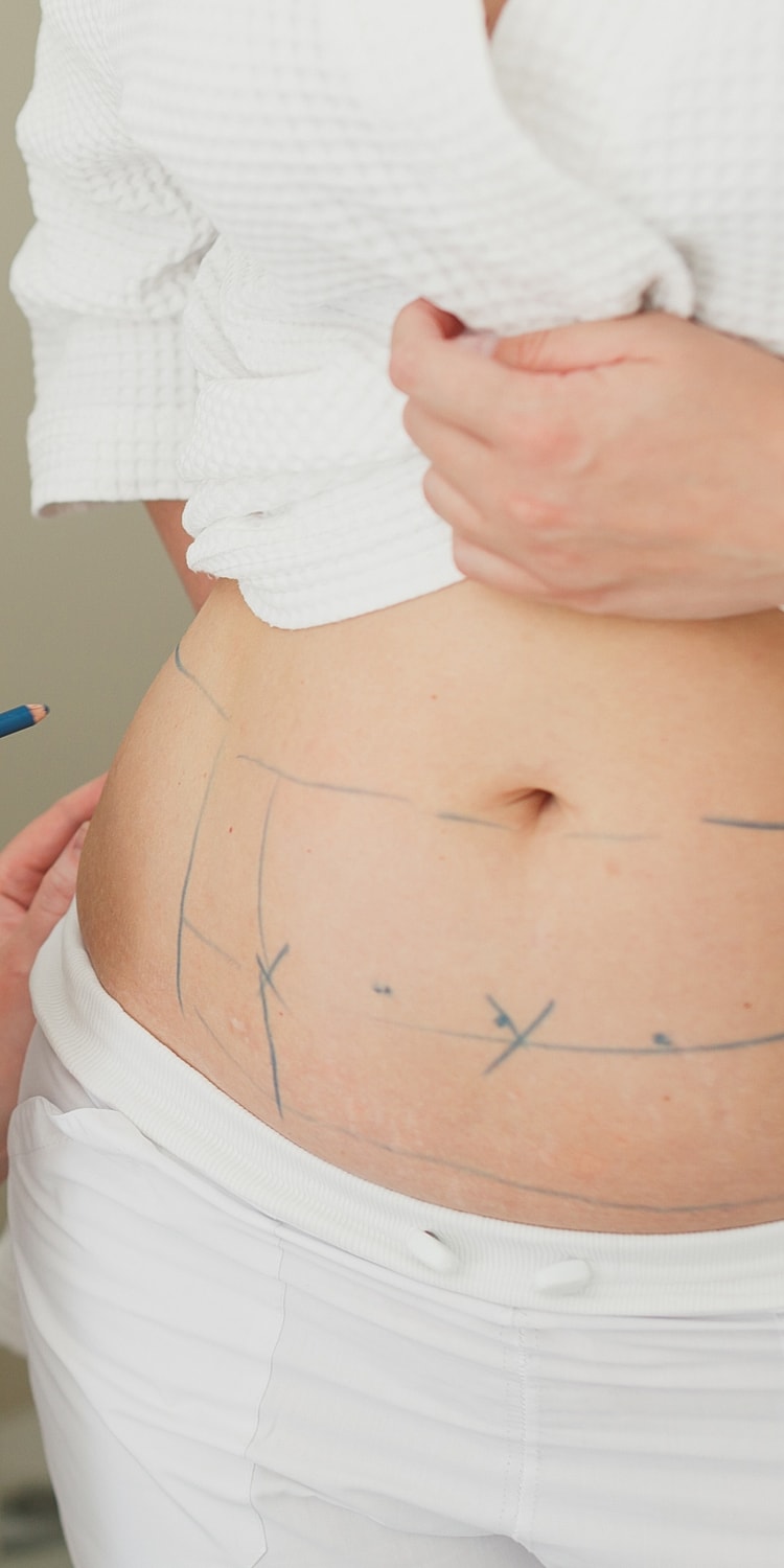 Body markings for cosmetic procedure preparation.