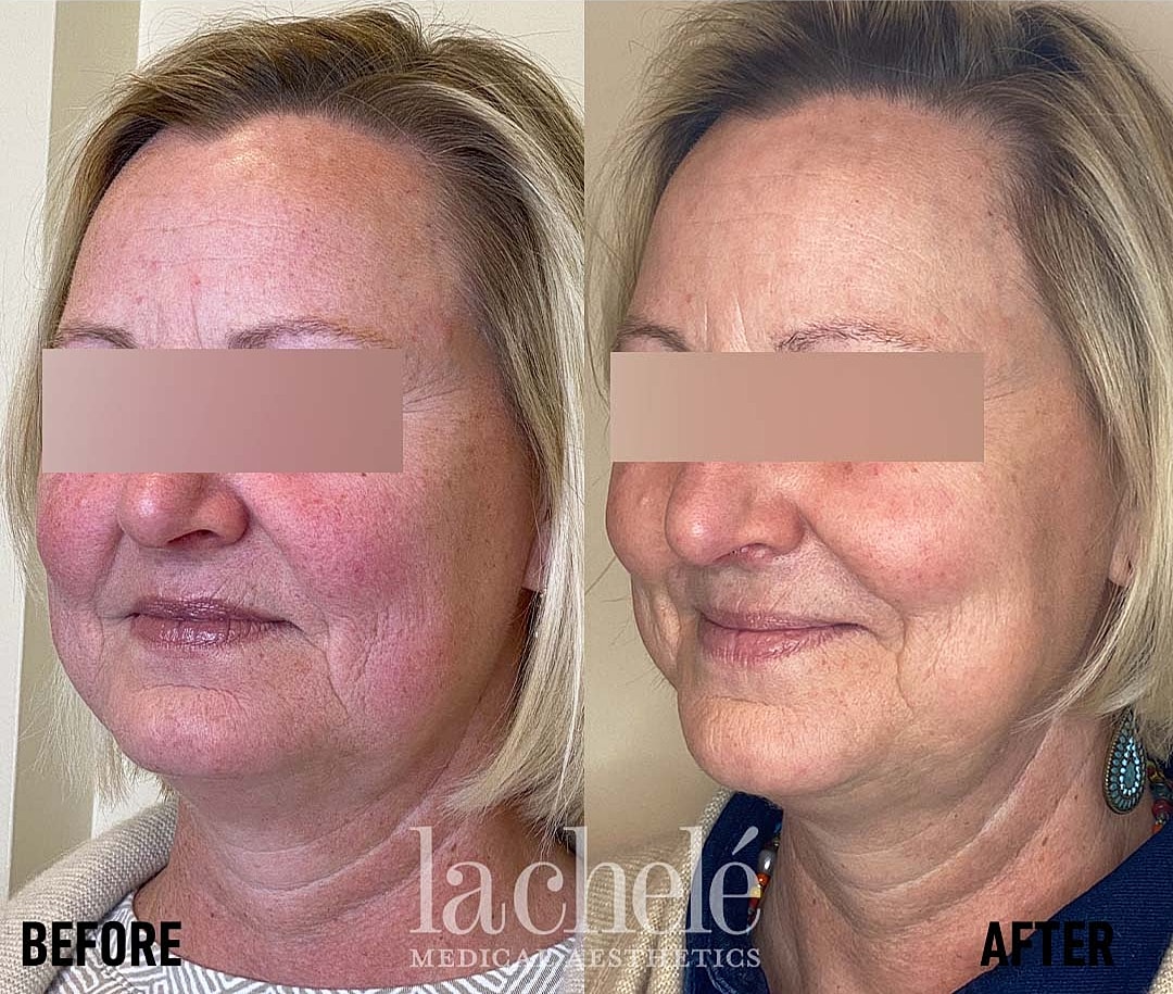 Before and after cosmetic treatment comparison image.