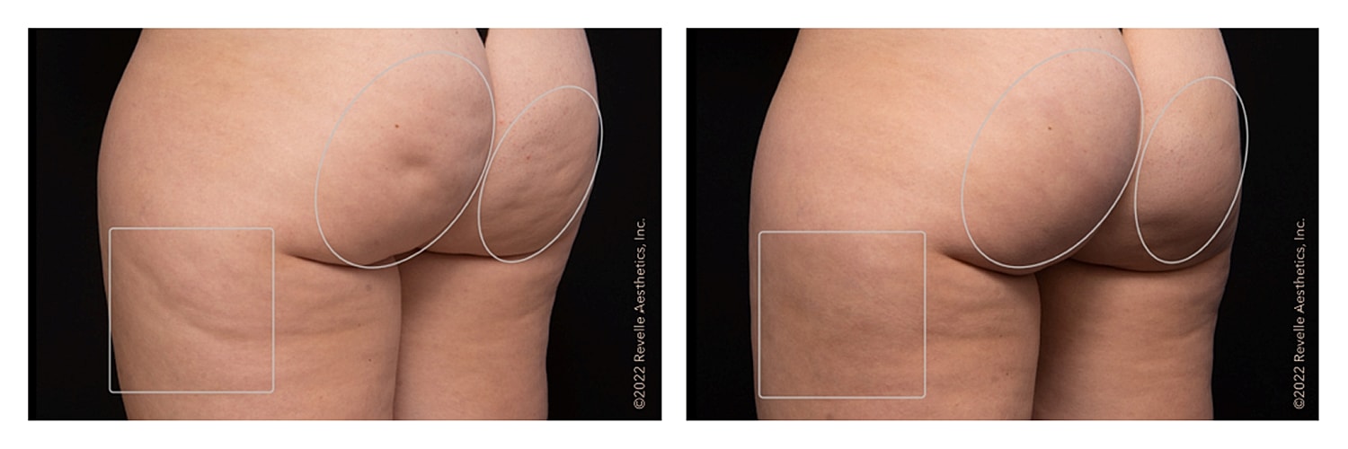 Before and after body contouring images.