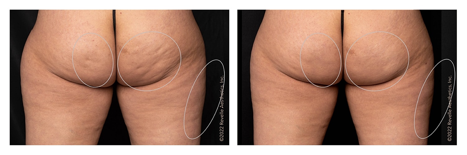 Before and after body contour treatment comparison.