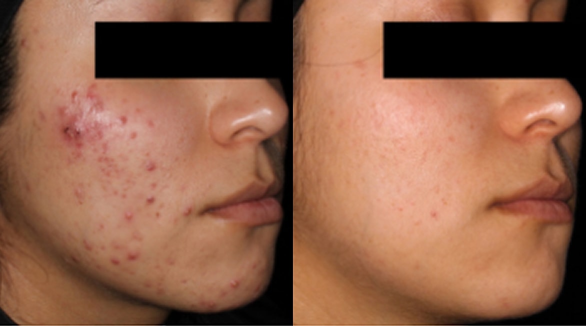 AviClear: Before - 12 Months After Final Treatment Session