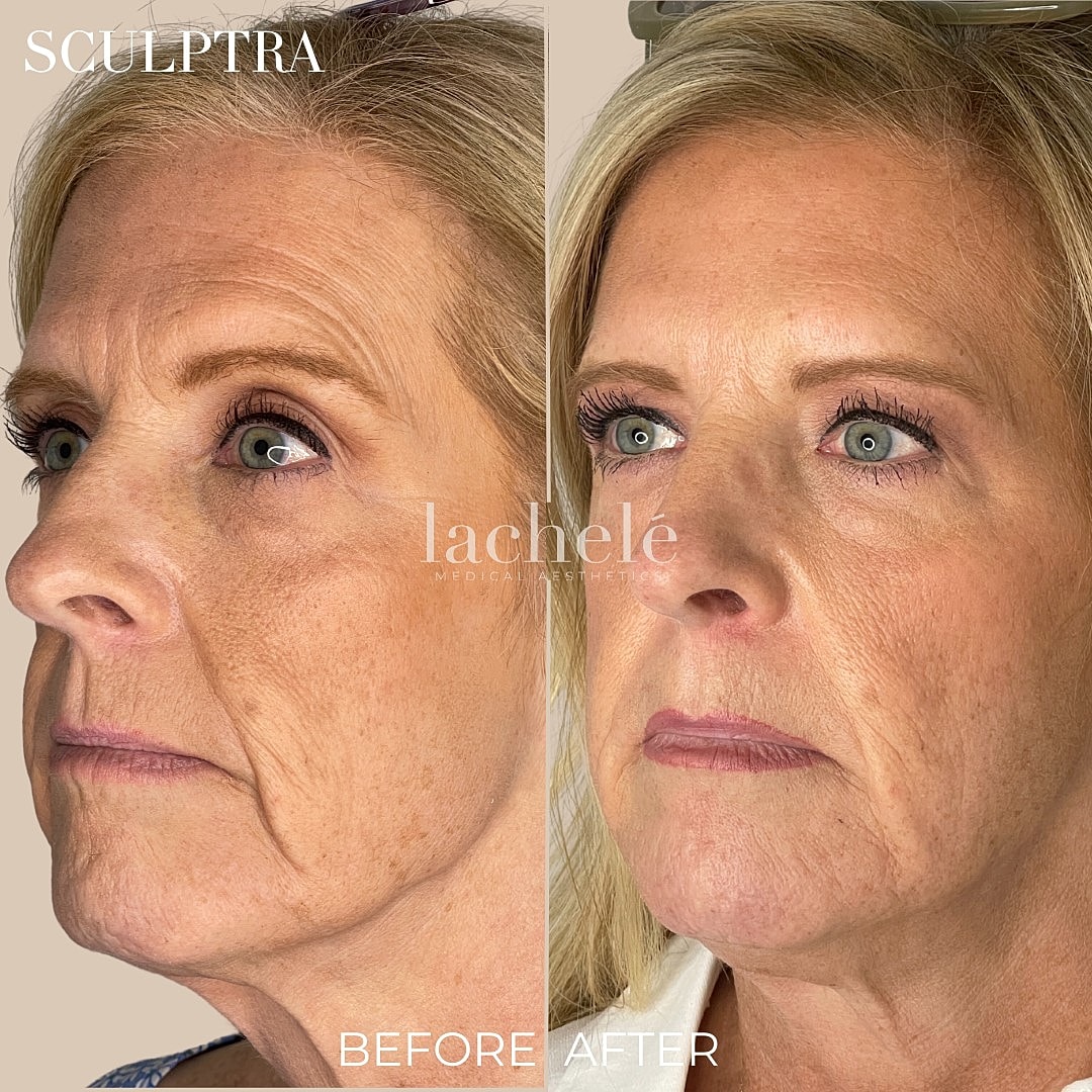 Sculptra treatment before and after results.