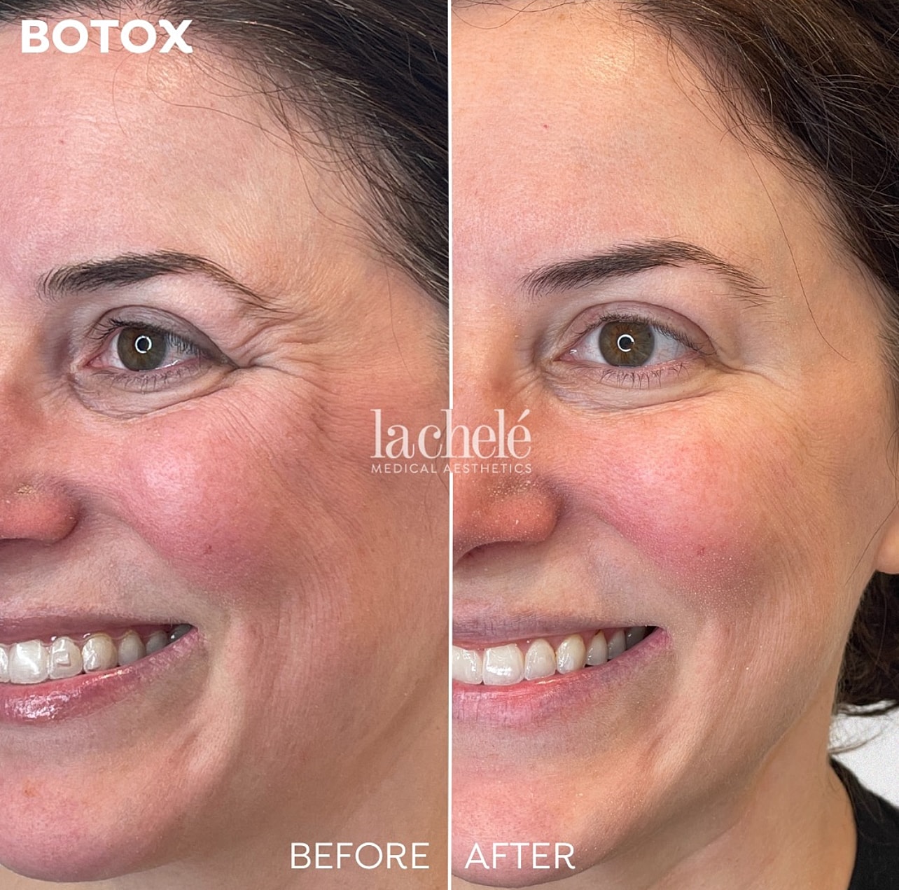Before and after Botox crows feet