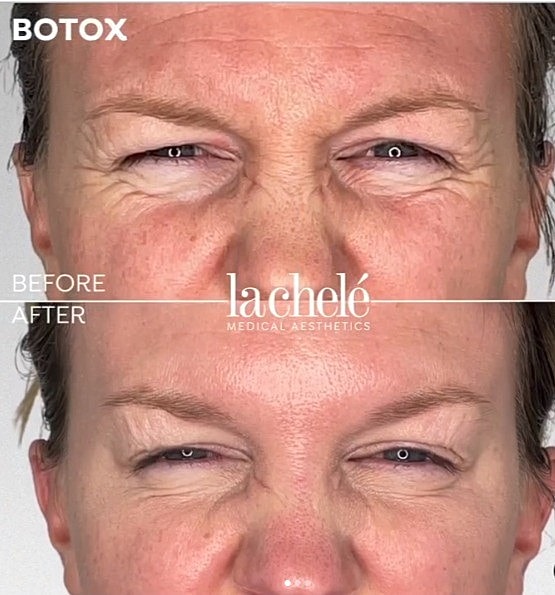 Before and after Botox crows feet