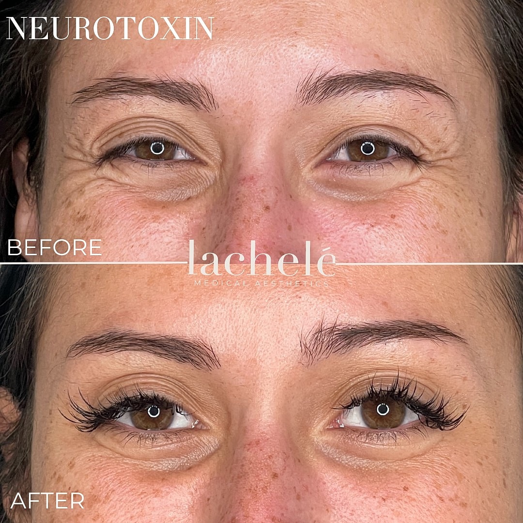 Before and after neurotoxin treatment results.