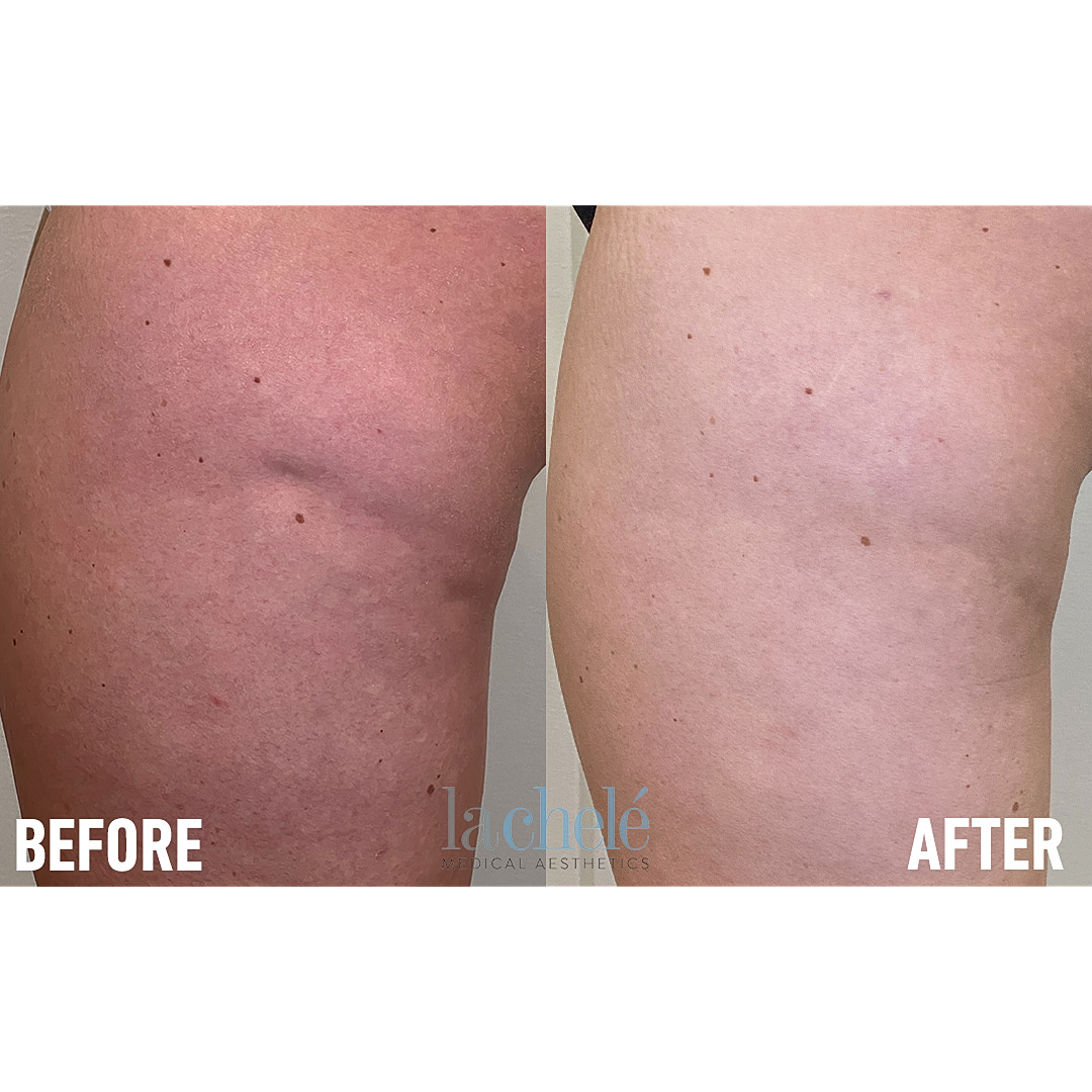 Before and after skin treatment comparison.