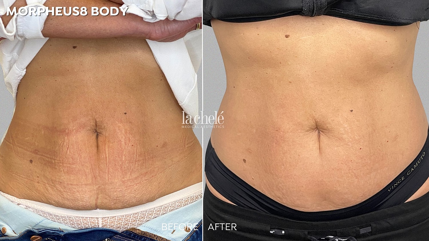 Morpheus8 body before and after transformation.