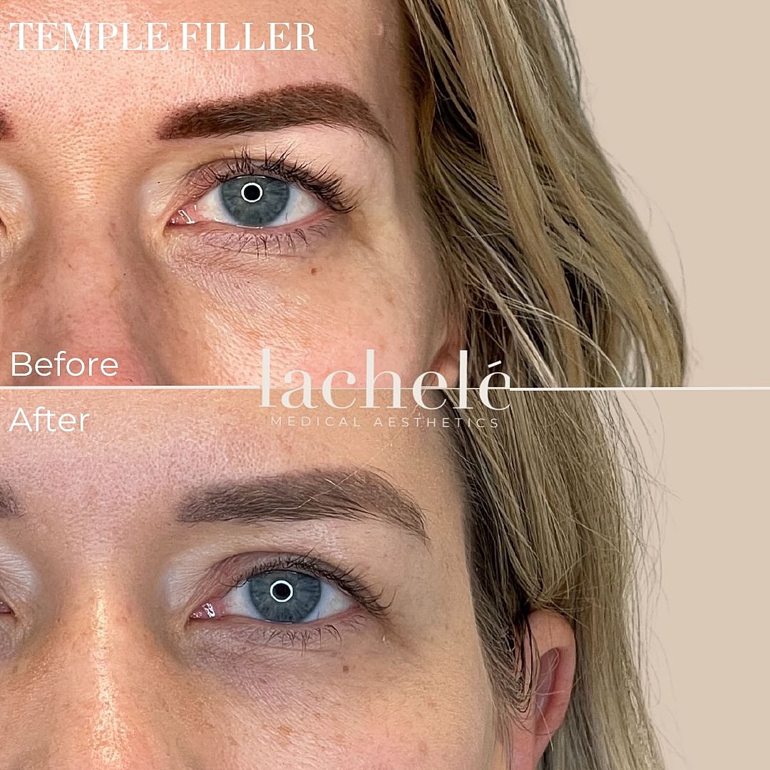 temple filler before and after treatment comparison.