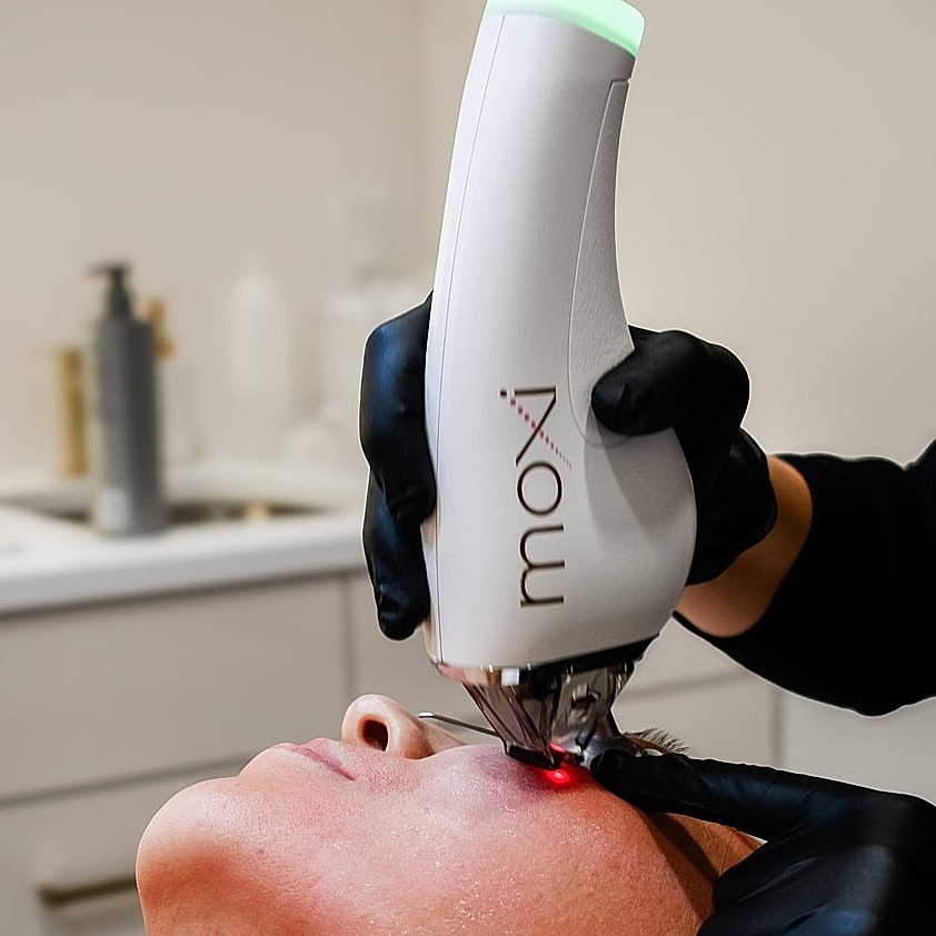 Woman receiving facial treatment with laser device.