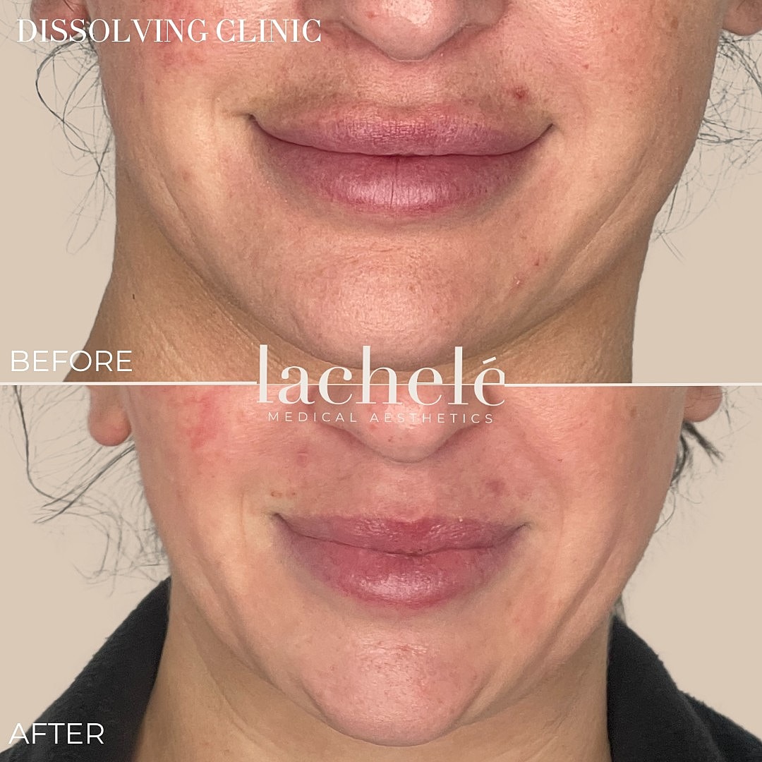 Before and after lip enhancement treatment results.