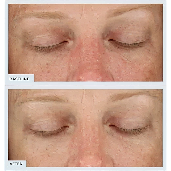 Before and after skin treatment comparison.