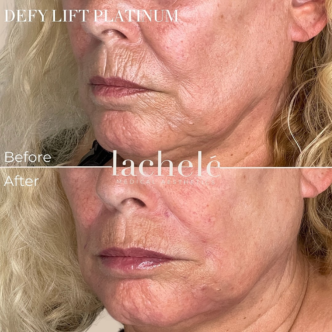 Before and after photos of facial treatment results.