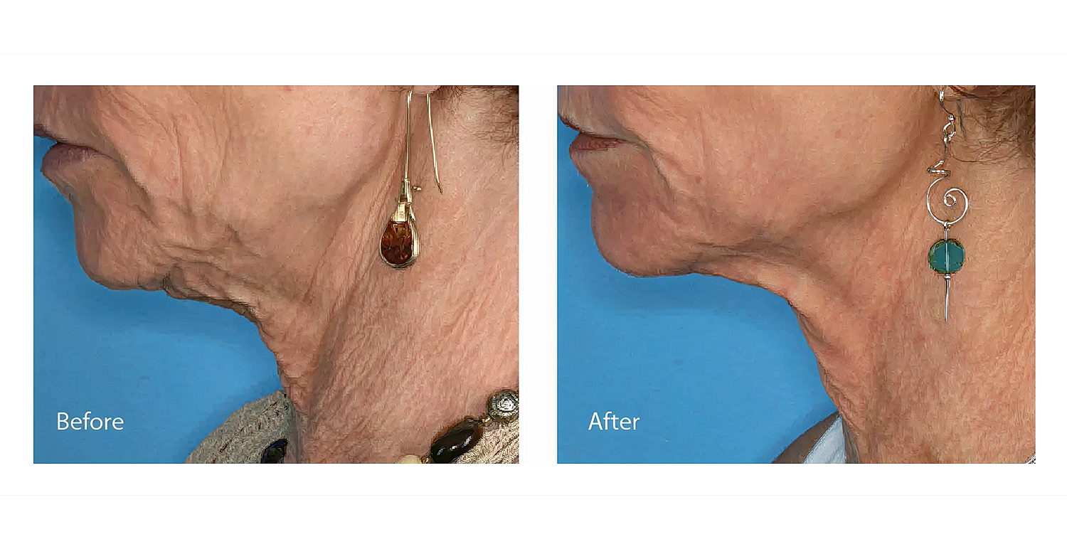 Before and after cosmetic procedure comparison.