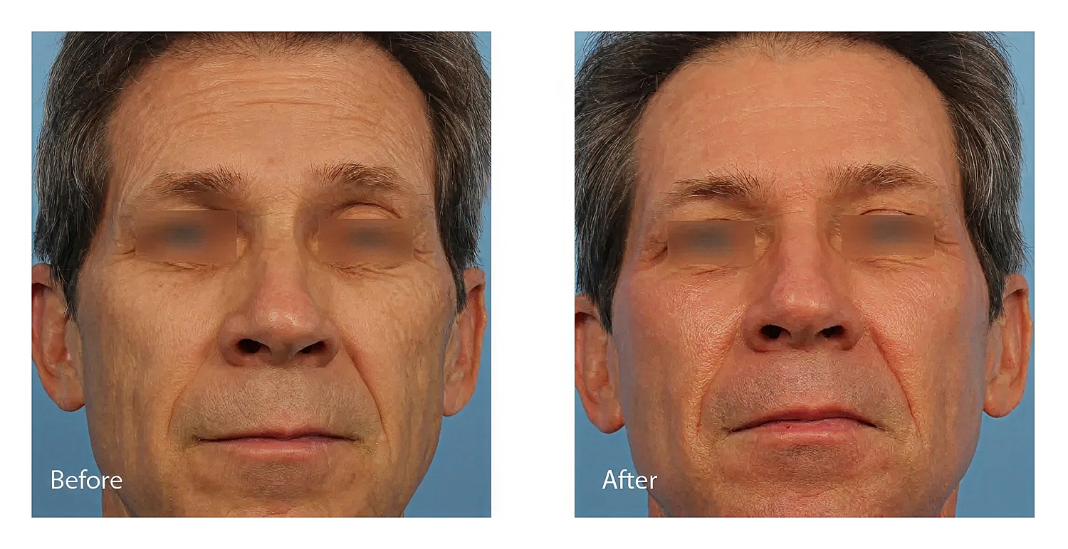 Facial transformation before and after treatment.