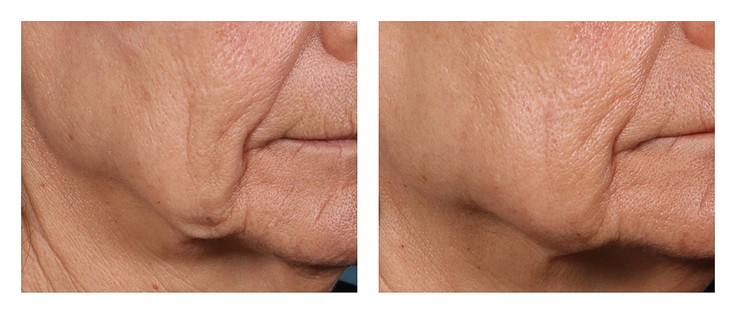 Before and after images of skin treatment results.