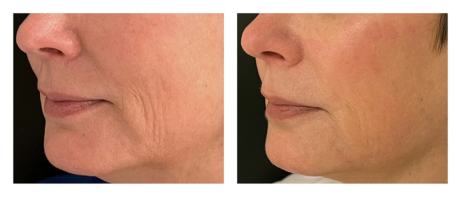 Before and after treatment for facial wrinkles.