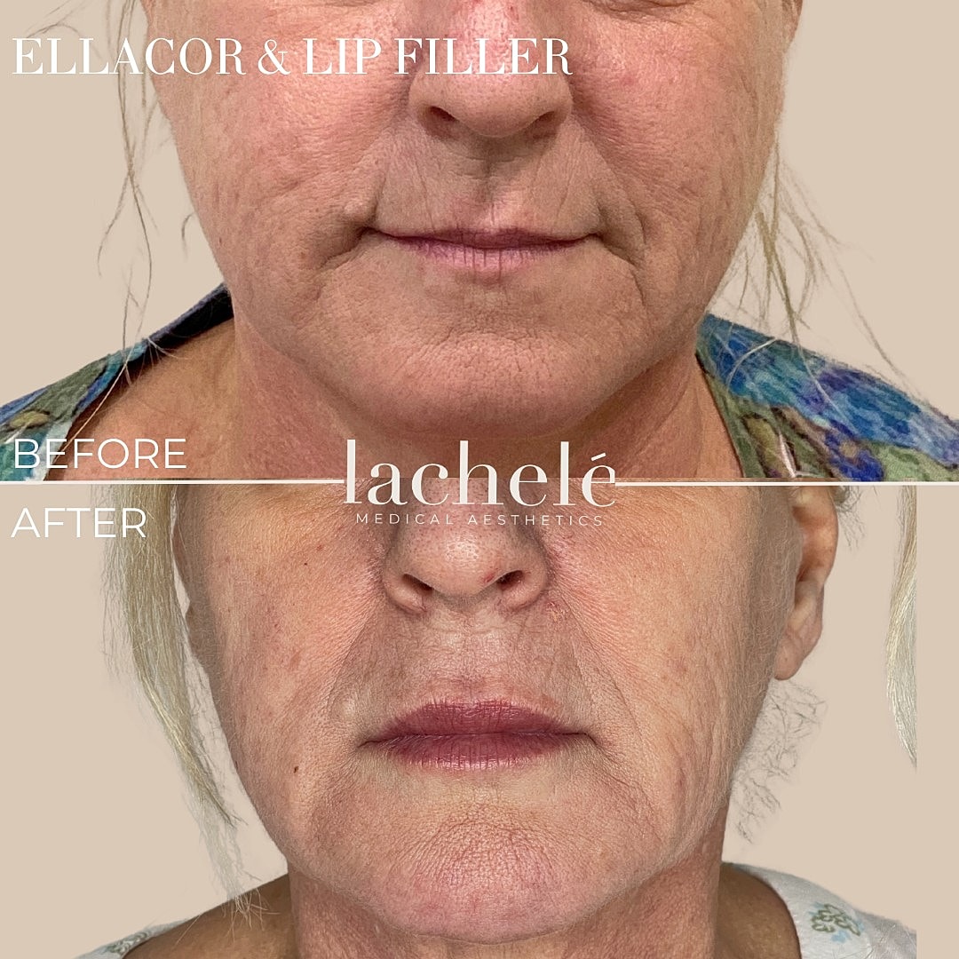 Before and after lip filler treatment results