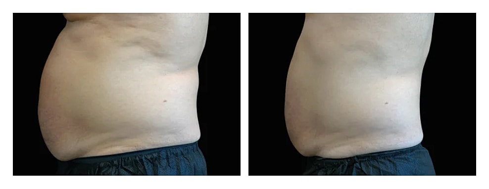 Before and after weight loss side view.