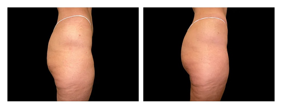 Before and after body contouring comparison.