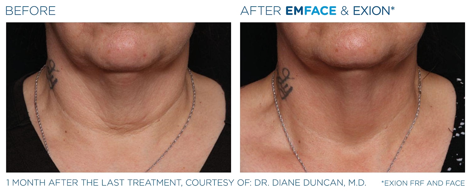 Before and after EMFACE treatment results