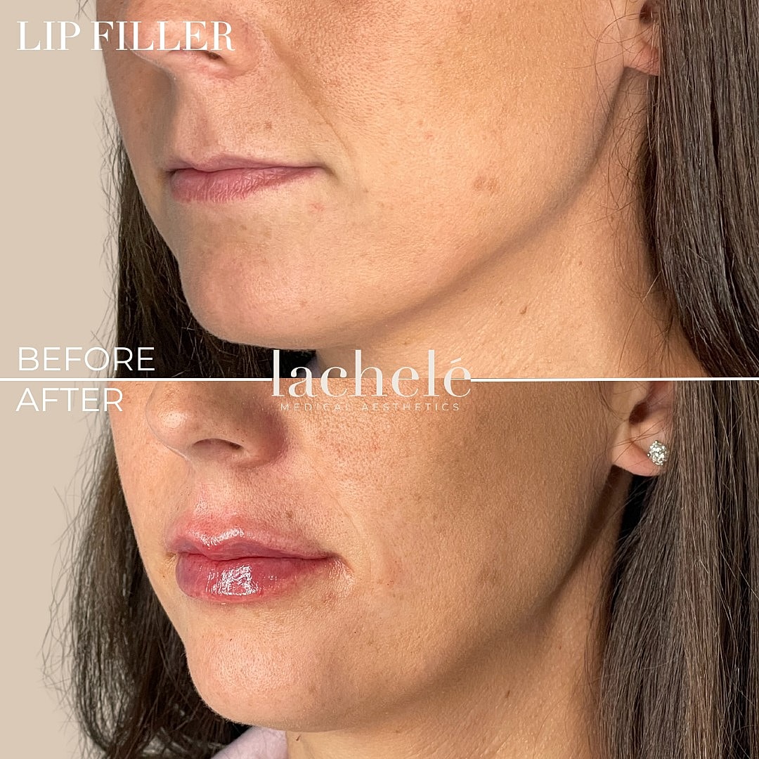 Lip filler before and after transformation image.