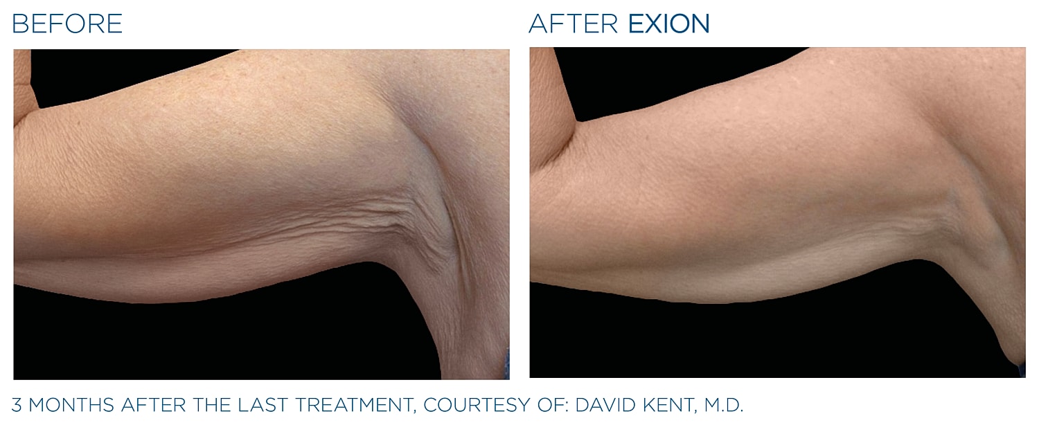 Arm treatment results: before and after Exion.