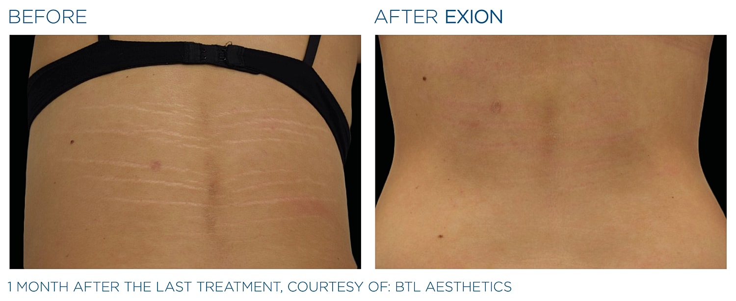 Before and after skin treatment results comparison.