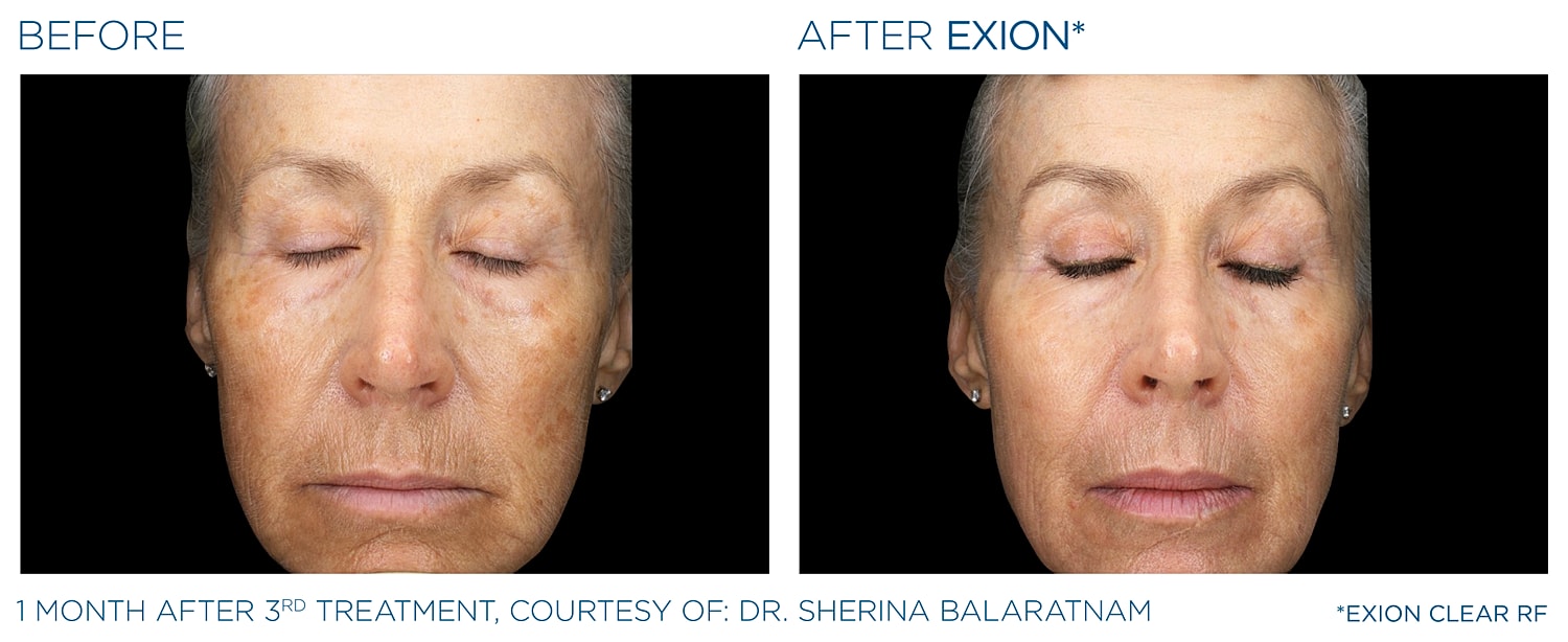 Before and after Exion skin treatment results.