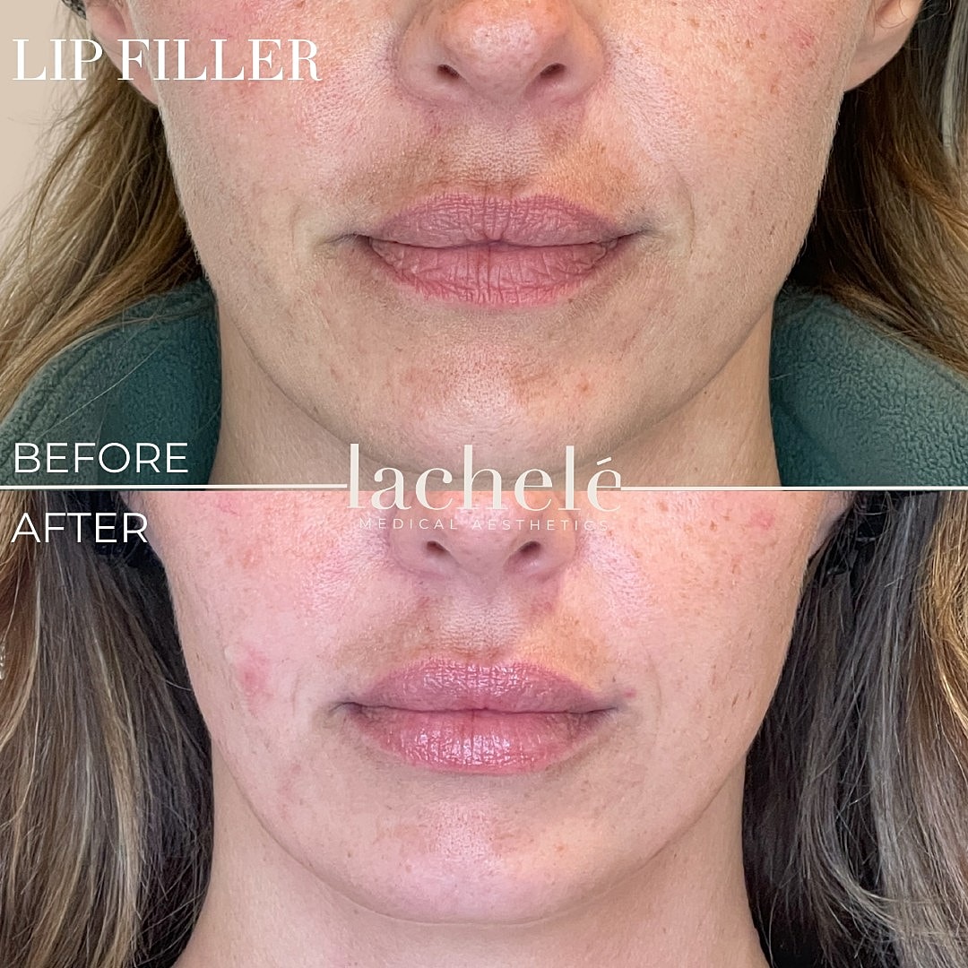 Lip filler before and after treatment comparison.