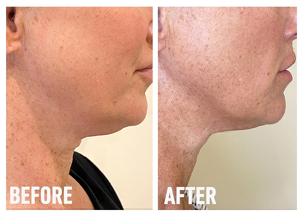 Before and after jawline transformation comparison.