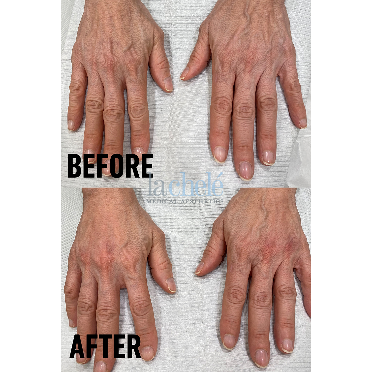 Hand rejuvenation before and after treatment comparison.