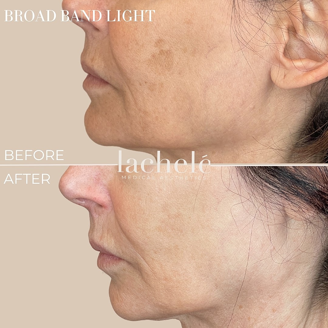 Before and after broad band light treatment results.