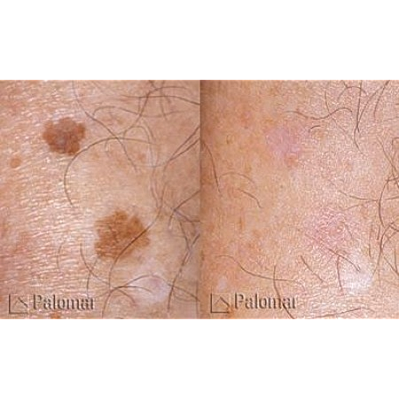 Skin pigmentation before and after treatment comparison.