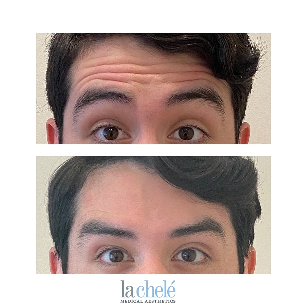 Before and after neurotoxin treatment results.