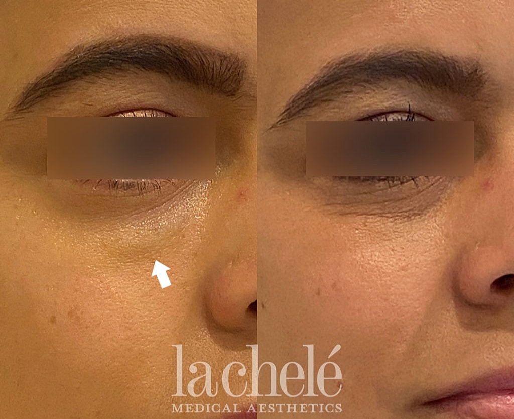 Before and after facial aesthetic treatment comparison.
