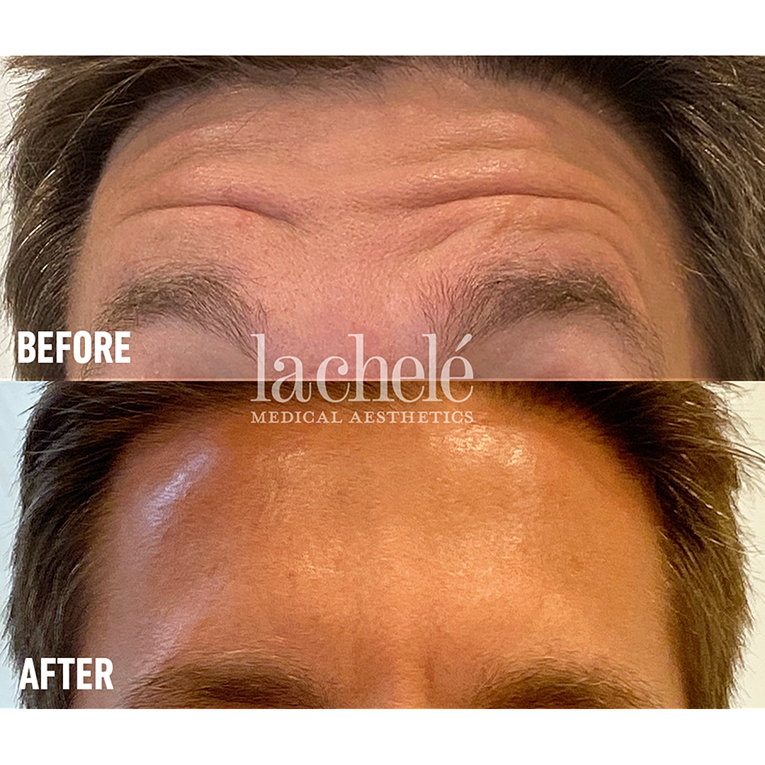 Before and after forehead wrinkle treatment comparison.