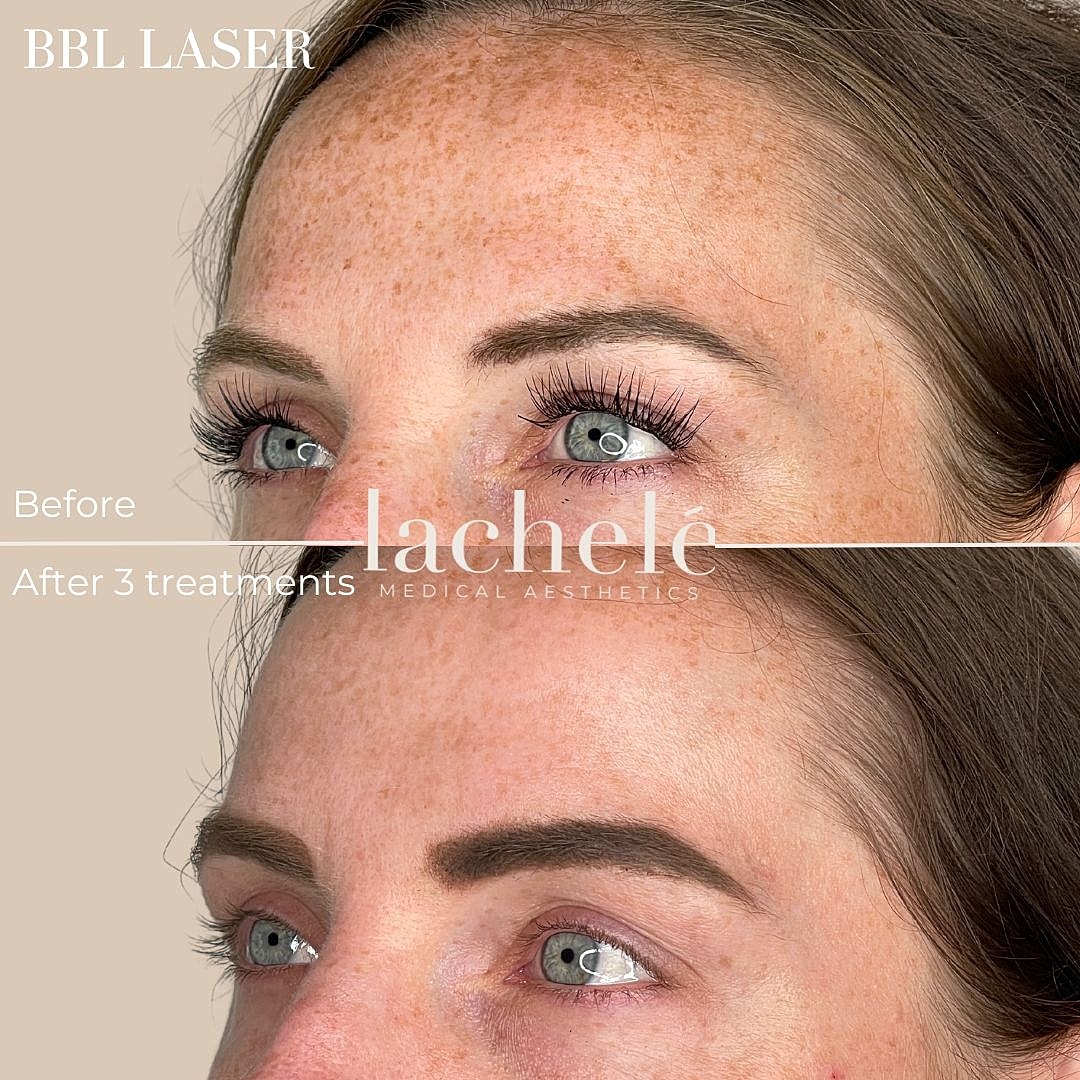 BBL laser treatment before and after results.