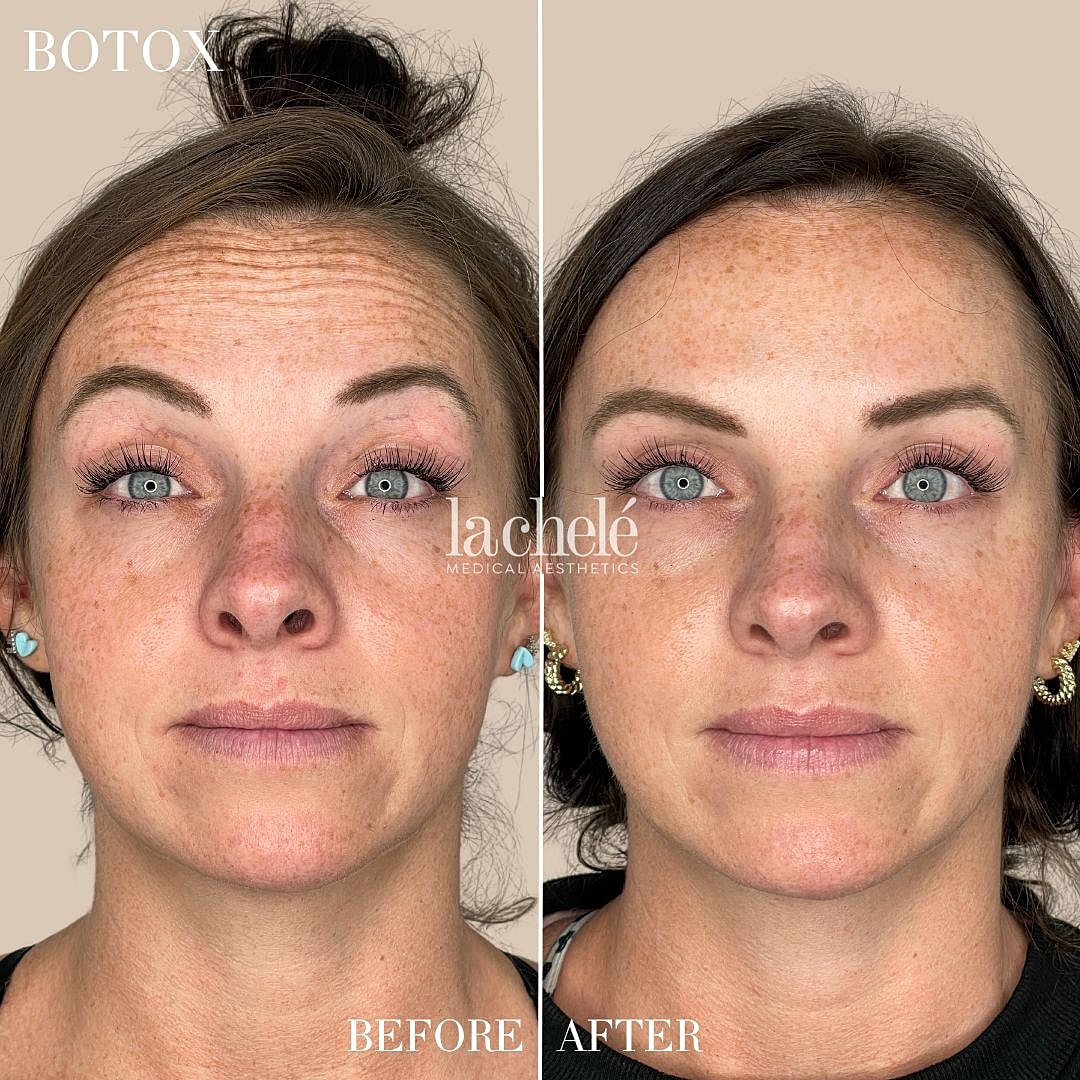 Botox treatment before and after comparison.