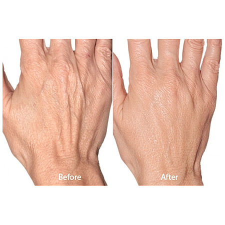 Comparative results of hand treatment before and after.