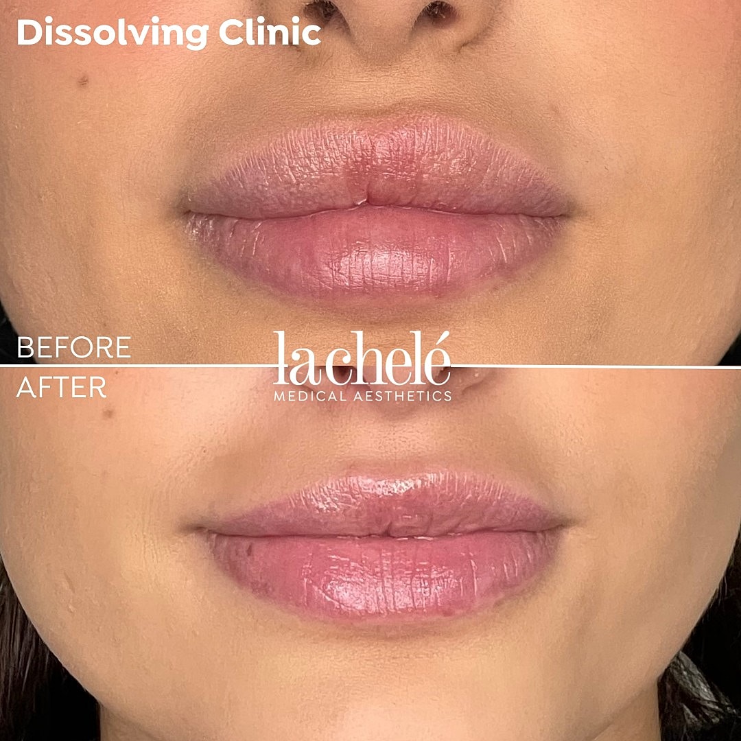 Lip enhancement before and after treatment.