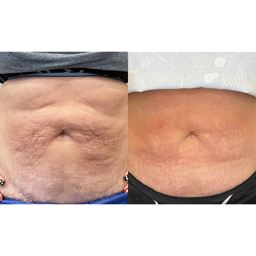 morpheus8 body before and after