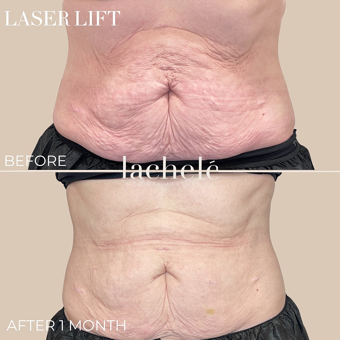 Before and after laser lift treatment comparison.
