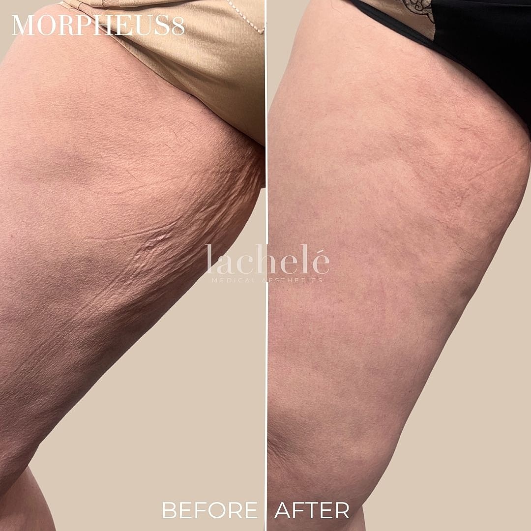 Morpheus8 treatment before and after results.