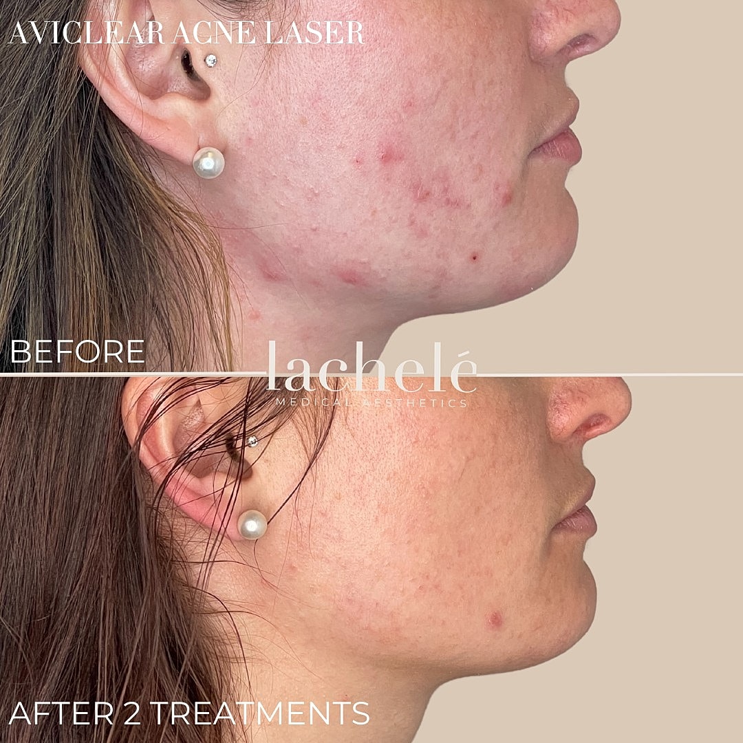 Acne treatment results: before and after comparison.