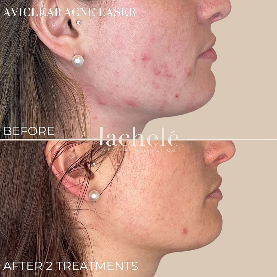 Before and after acne laser treatment comparison.
